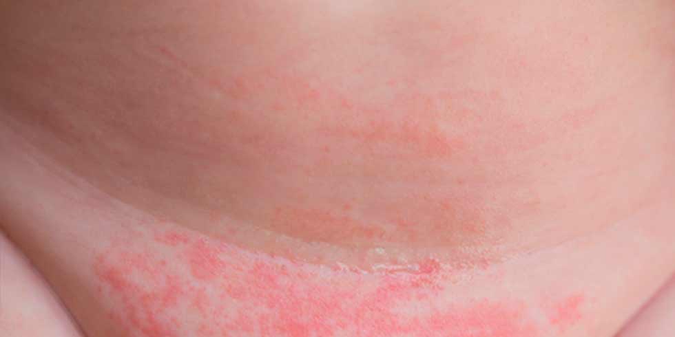 Como tratar la dermatitis del pañal
